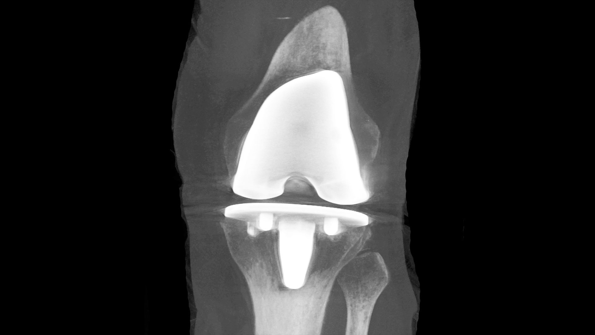 Knee replacement