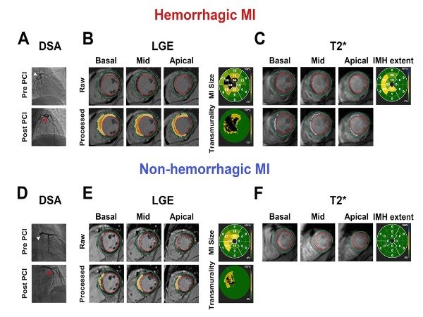 Hemorrhagic vs Non-hemorrhagic