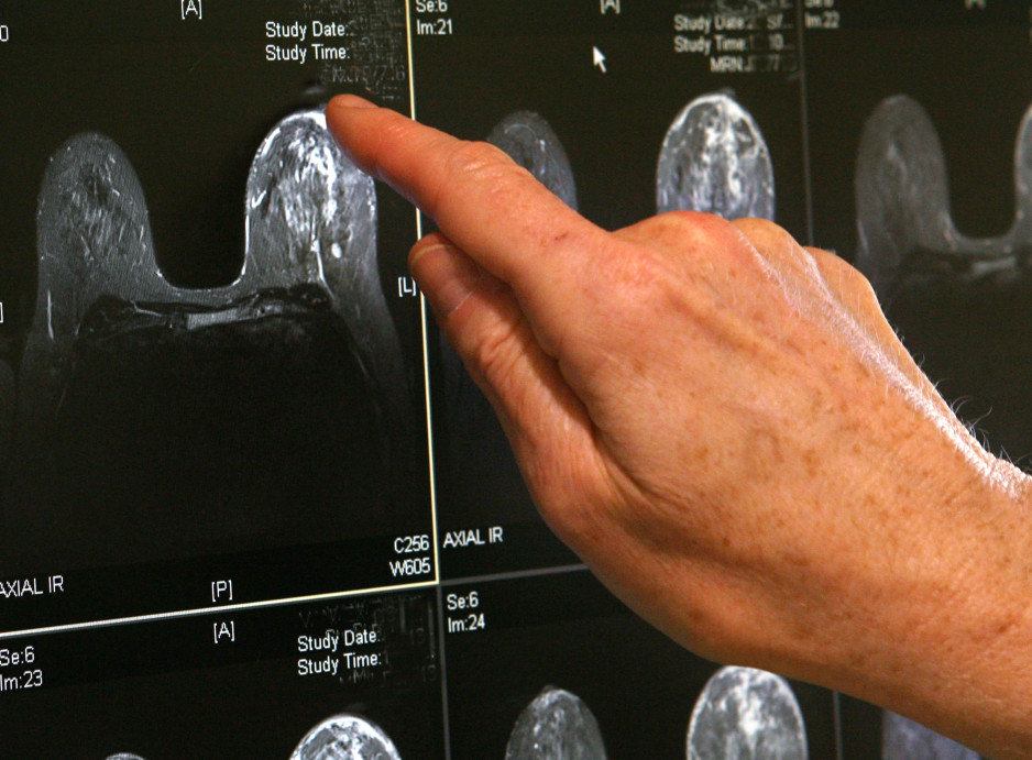 a hand points at medical image of a breast